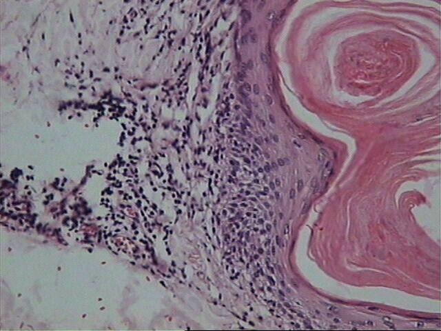 Fig.9. Epidermotropismo folicular - <div style=